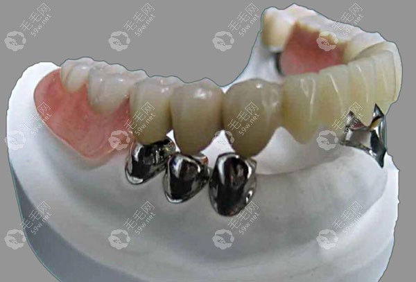 套筒冠义齿也叫无挂钩覆盖义齿,有固定松动牙保残根的作用