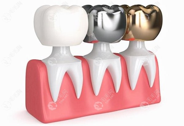 不同材质的牙冠修复体