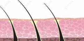 脱发给头皮打针注射的什么?有激素、CGF、头皮营养针3种
