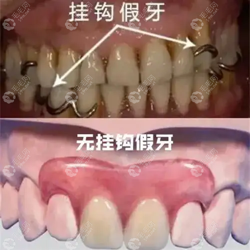 挂钩假牙和无挂钩假牙的区别