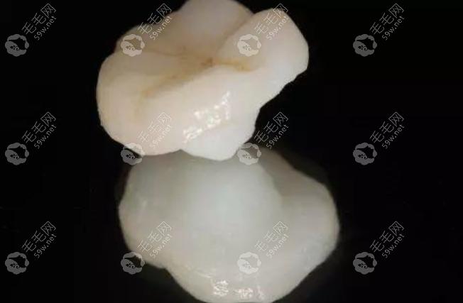 牙齿嵌体是什么材料这么贵？