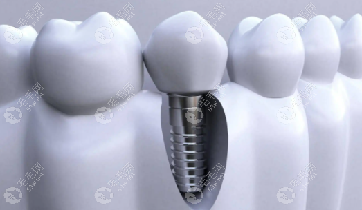 解析一颗种植牙的寿命和价格,看便宜的种植牙能维持多少年