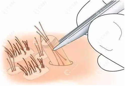 西安大麦微针艺术眉毛种植技术