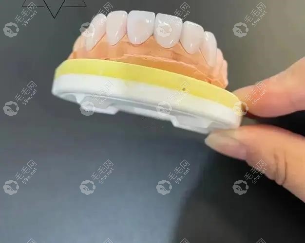 牙齿贴面结构示意图