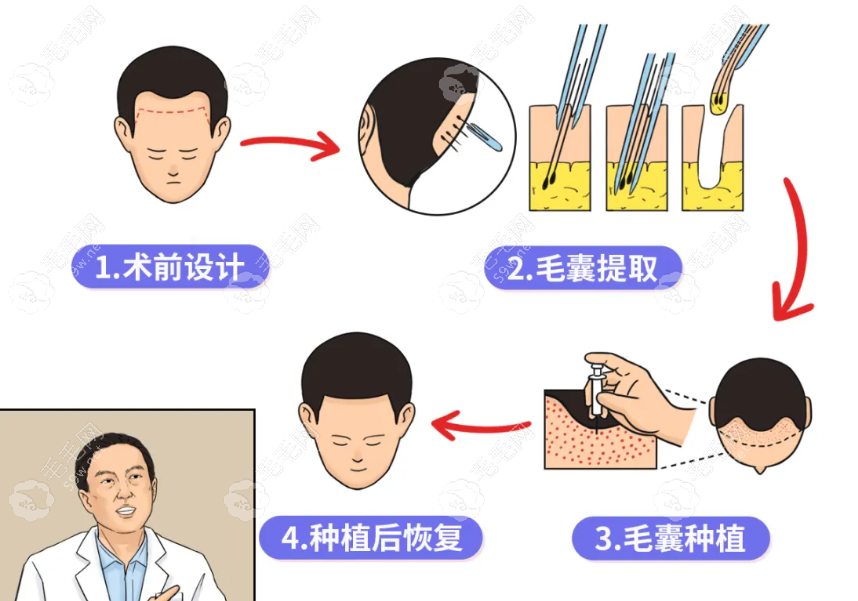 内蒙古包头植发际线流程