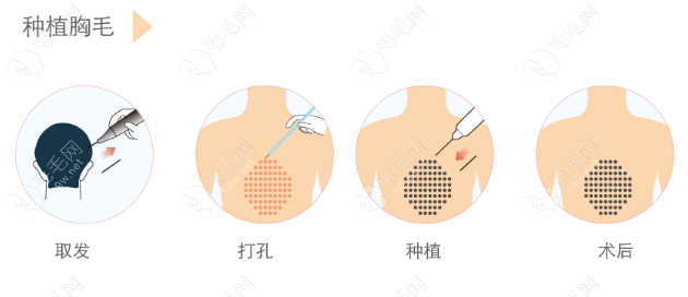 胸毛种植过程图片