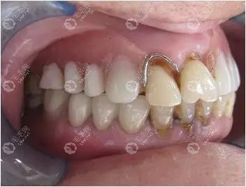 假牙挂钩好还是不挂钩的好