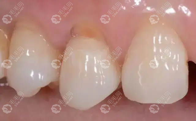 楔状缺损到什么程度需要补牙