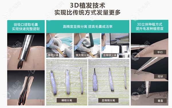 郑州新生植发3D技术解说