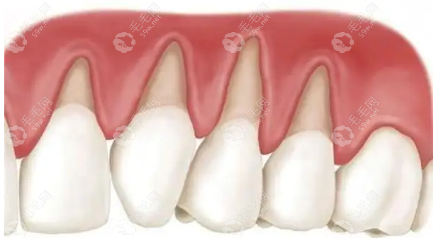 种植牙后牙龈萎缩怎么办