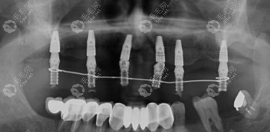 种植牙几年后牙床全烂了,是牙龈萎缩/发炎等后遗症导致的吗