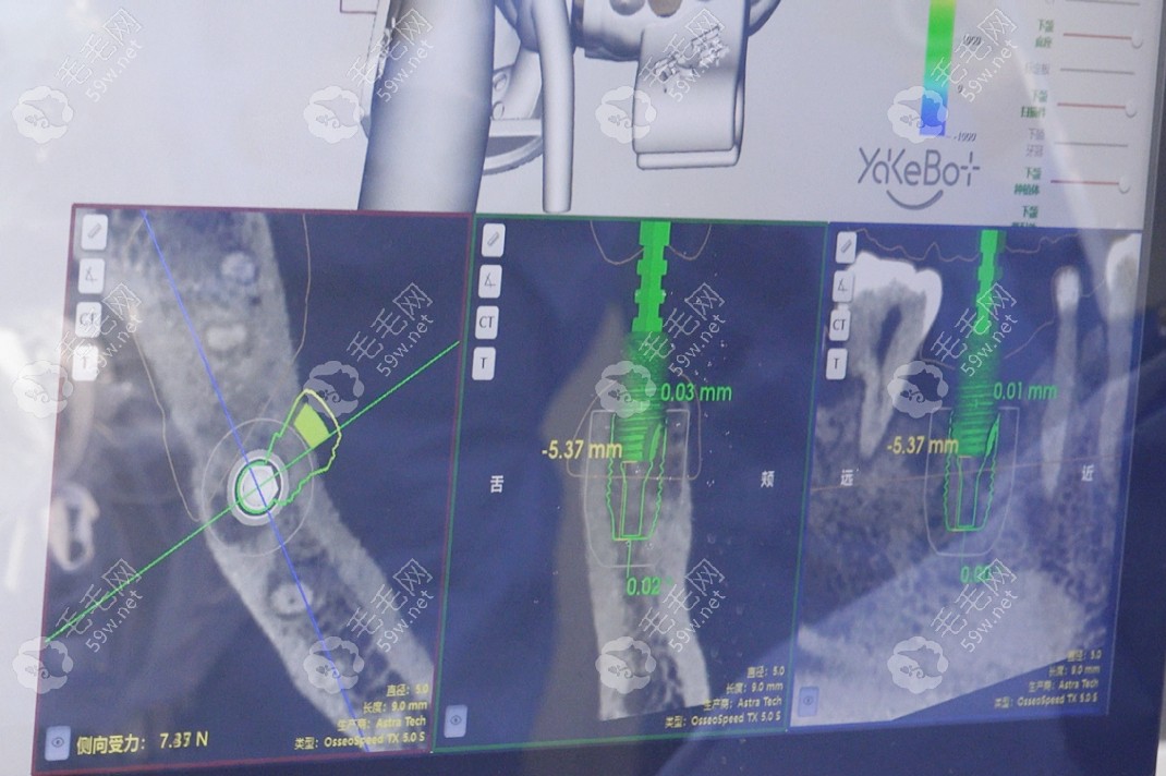 雅悦齿科的机器人种植手术方案模拟