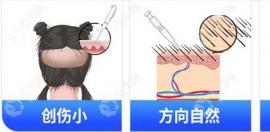 上海头发加密植发医院排名:3大正规植发机构加密植发技术好