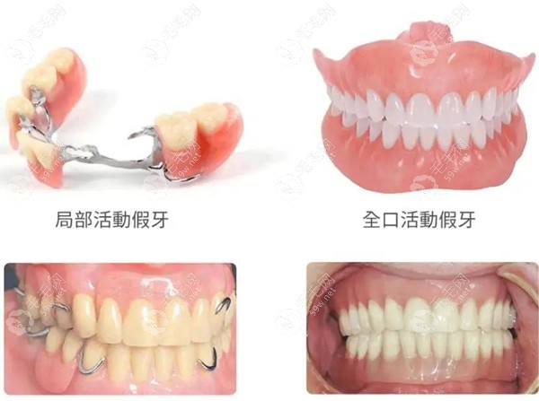 局部活动假牙和全口活动假牙区别