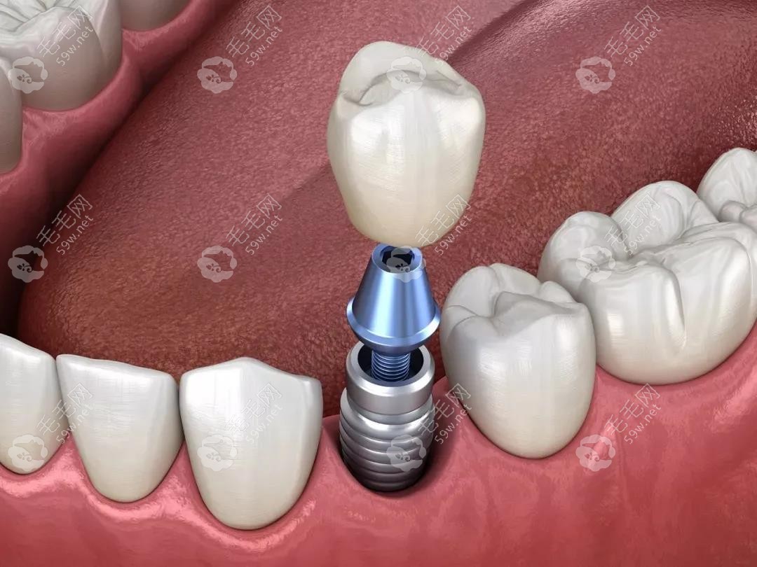 种植牙是一种比较好的修复方法