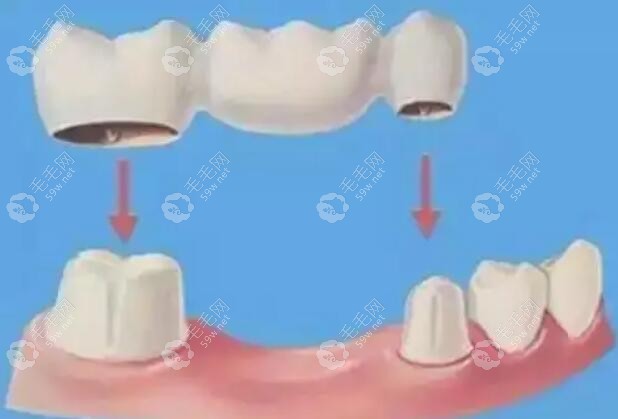带固定假牙的修复方式www.59w.net