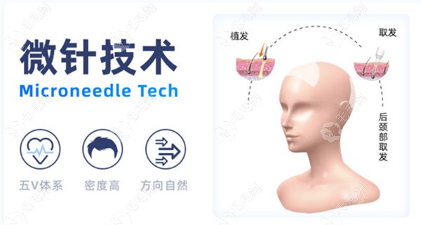 重庆微针技术种植发际线价格