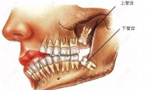 为什么医生都建议将智齿给拔了,细数6大非拔不可的智齿图