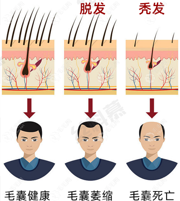 丝科慕和米诺地尔哪个疗效好,治疗脂溢性脱发/雄脱选谁？