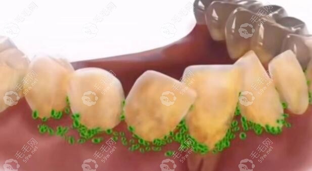 牙周有炎症怎么做矫正