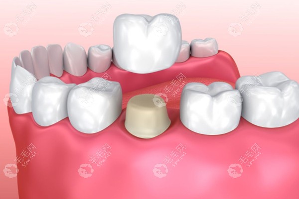 做根管治疗后需做牙冠修复的原因