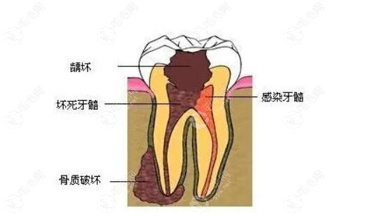 重度牙髓炎发生的瘘管