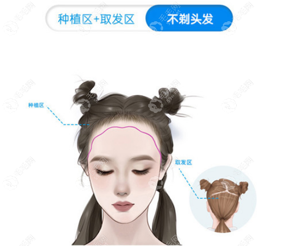 广州首瑞专注不剃发毛发移植技术59w.net
