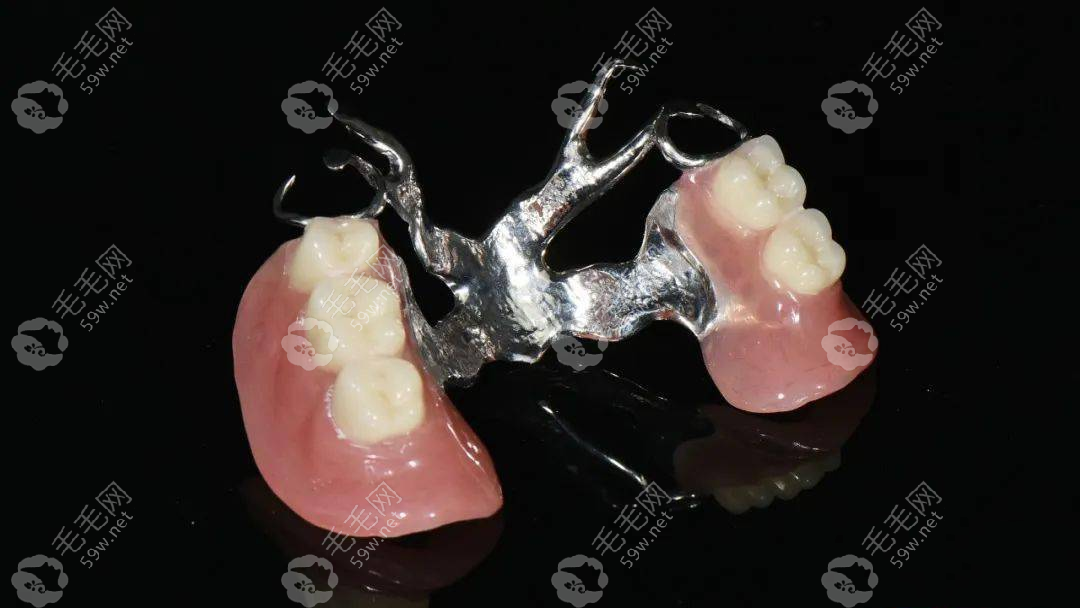 维他灵义齿支架的优缺点