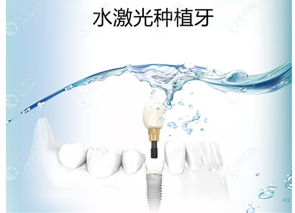 水激光种植牙技术优势是什么?公办医院为啥不用水激光种牙