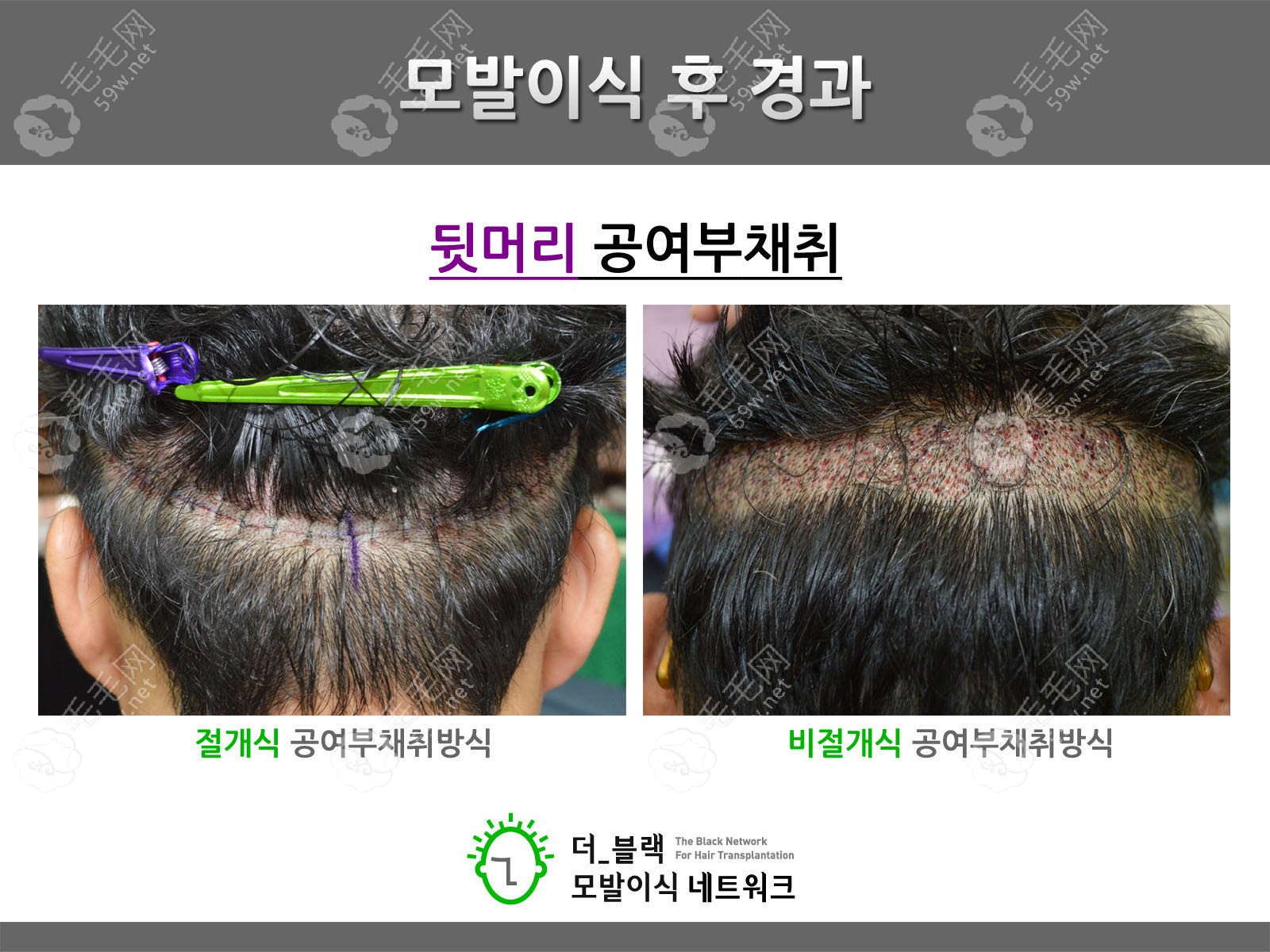 韩国布莱克切开法植发和非切开法植发的区别图片对比