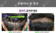 韩国布莱克植发实例图片:对比切开法和非切开法植发的区别