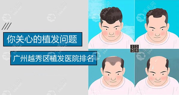 广州越秀区植发医院排名
