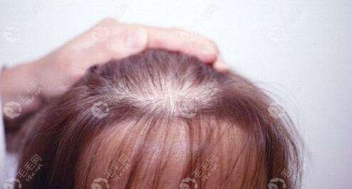 普通的发质按照干性、油性、中性来划分。