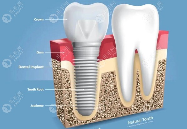种植牙包括哪些费用和材料?口腔种植费用明细清单给你答案