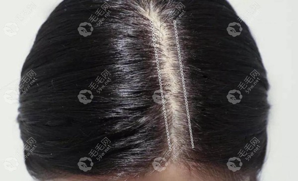 什么原因导致发缝变宽 毛毛网
