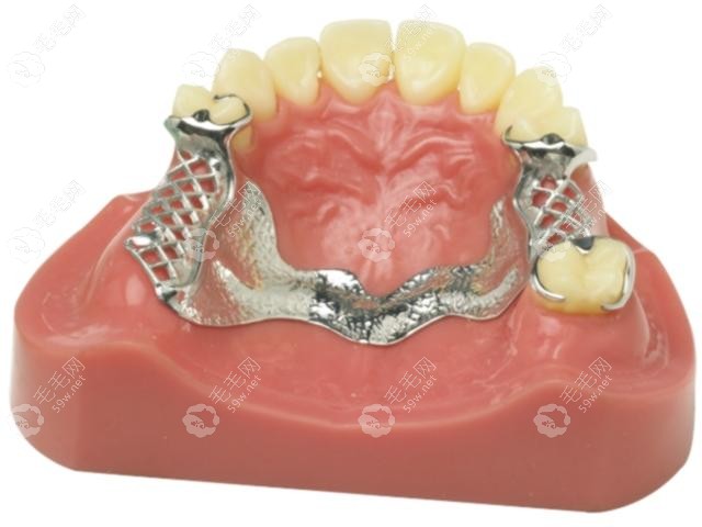 活动牙纯钛支架优缺点