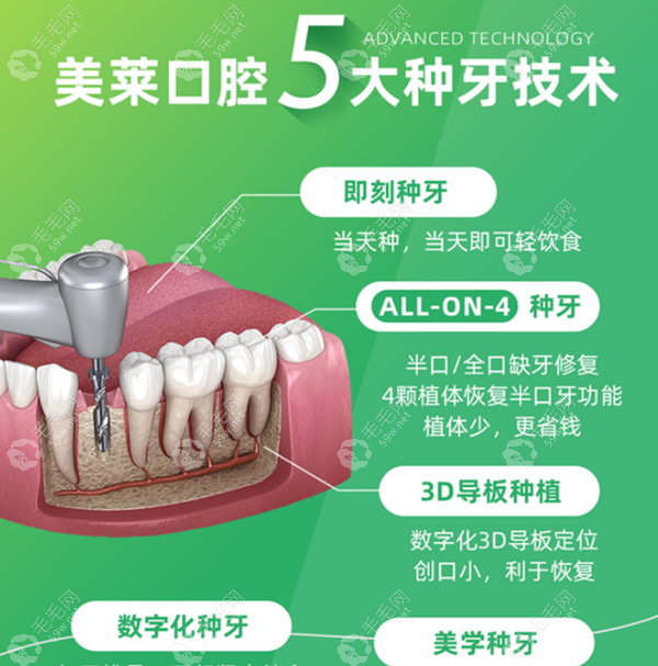 深圳美莱口腔5大种植牙技术