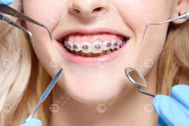 矫正牙齿只拔一边会影响吗?网传正畸只拔一侧牙齿中线歪