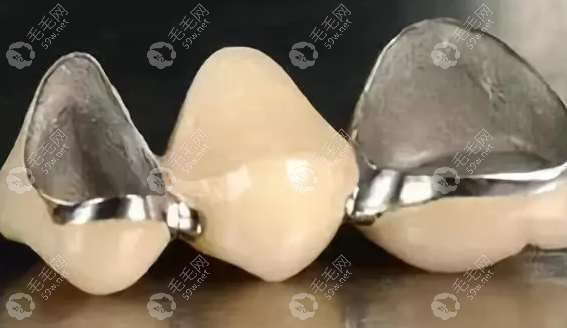 镶牙必须一次镶三颗吗?