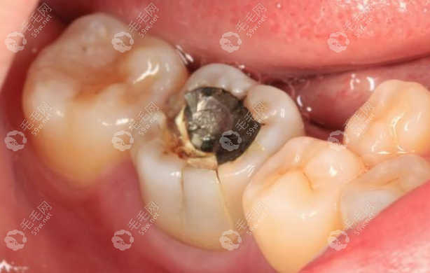 可以通过补牙,戴牙冠,或者拔掉做种植牙等方式修复,具体修复办法如下