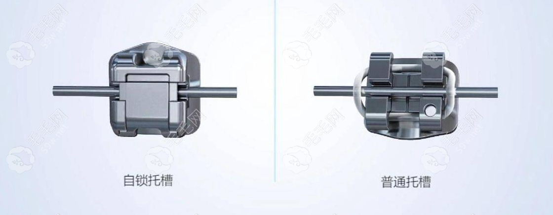 自锁托槽和传统托槽的区别