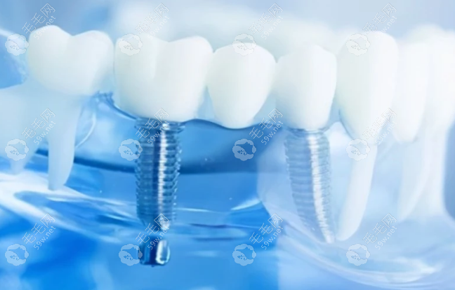 正规牙科医院种植一颗牙价格一般在：3000-2万元左右