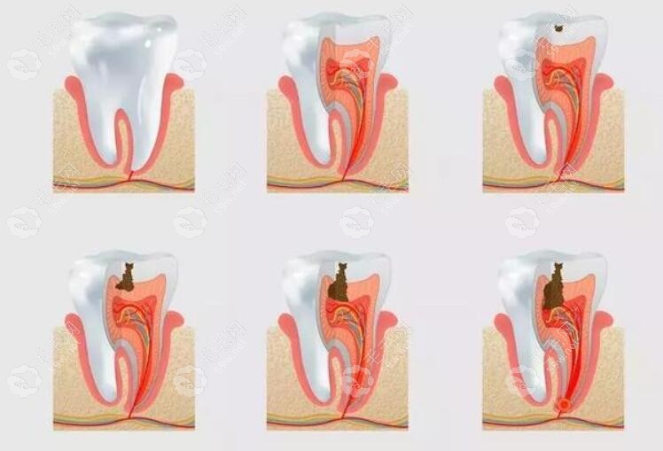 牙医故意把牙磨到漏神经怎么办?医生说牙神经已经不能保留