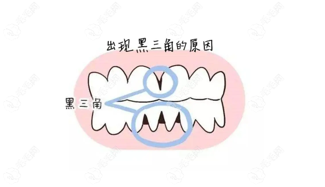 牙龈萎缩