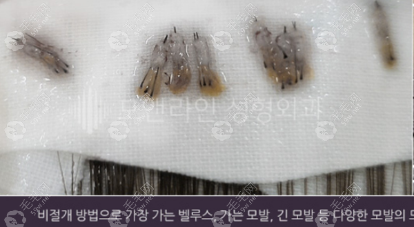 韩国毛莱茵植发提取毛囊
