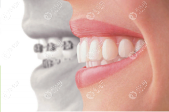 正畸牙套的种类和价格全解:看金属/隐形等5种类型的优劣势
