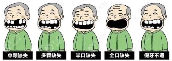 广州口腔医院种植牙收费标准