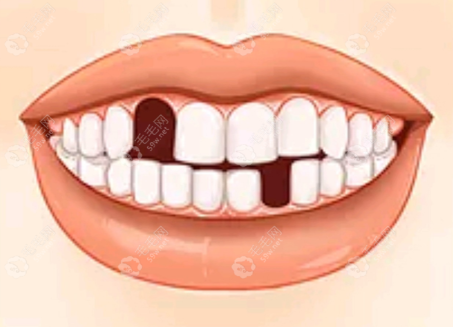 65岁以上老年人安什么假牙好,是该选种植牙还是镶牙好呢
