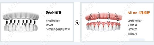 上海全口种植牙费用中档水平要多少钱