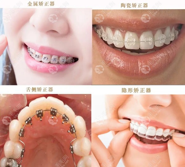 广州牙齿矫正价格表翻新,戴牙套收费明细是金属7k+/隐形1.5w+